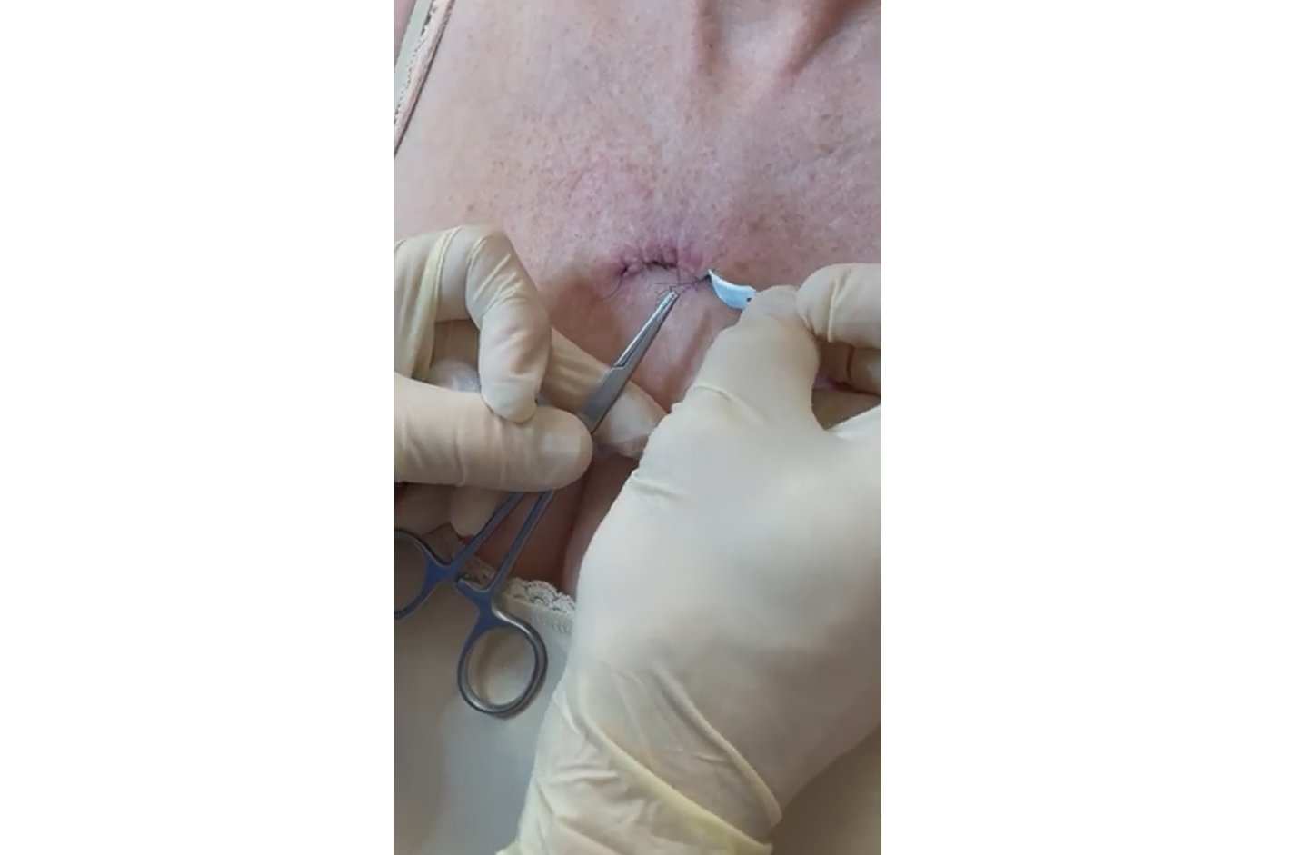 Remove a running suture